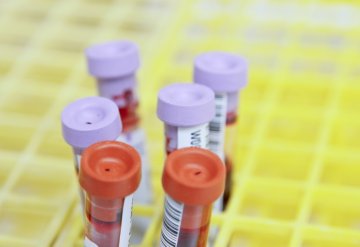 Preventivní krevní testy z pohledu funkční medicíny
